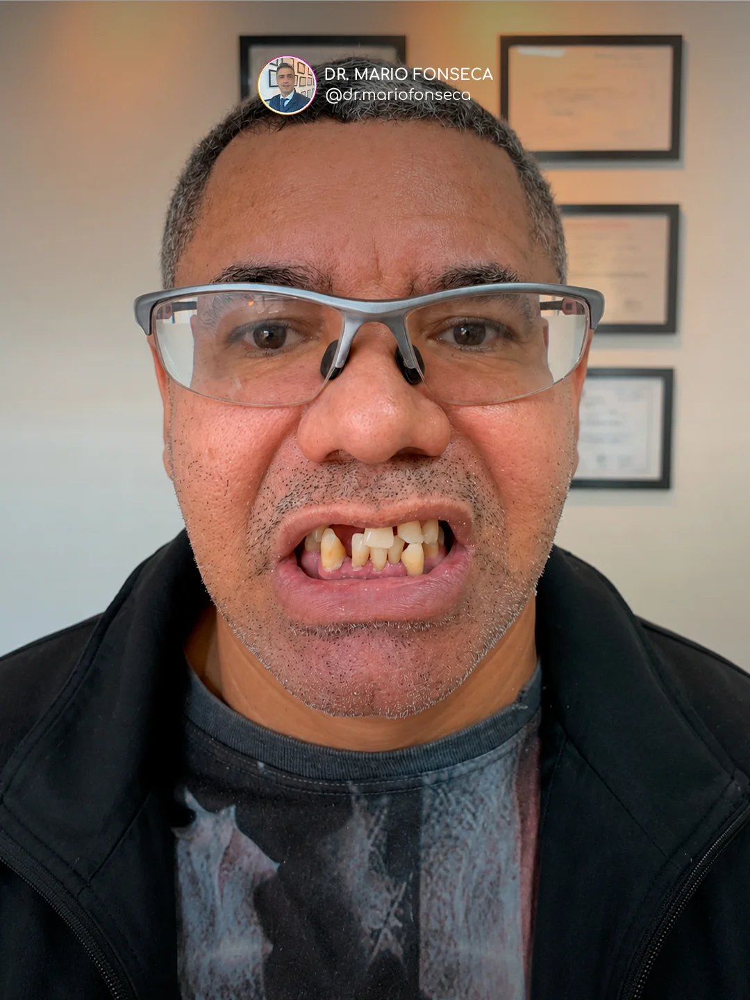 Antes - Implantes Dentários e Reabilitação Oral