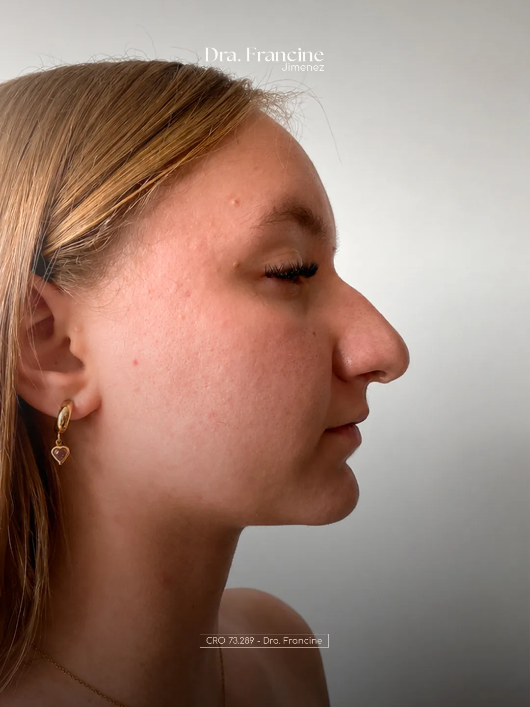 Antes - Estética Facial e Harmonização