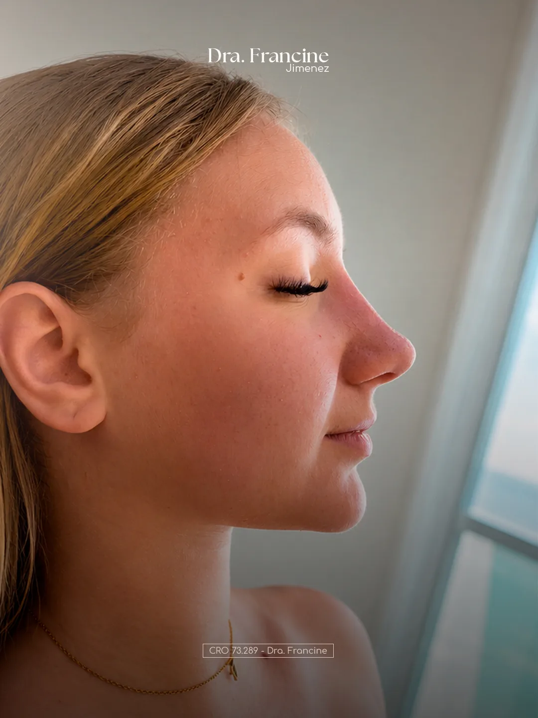 Depois - Estética Facial e Harmonização